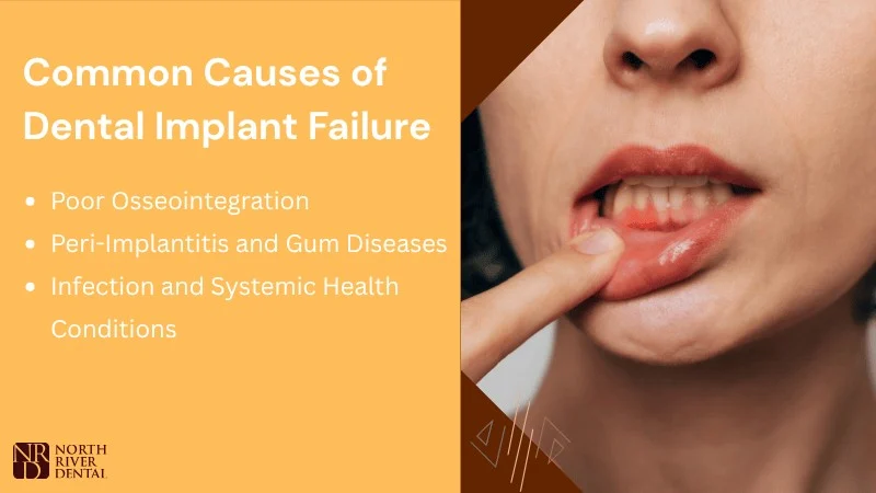 Major Causes of Dental Implant Failure