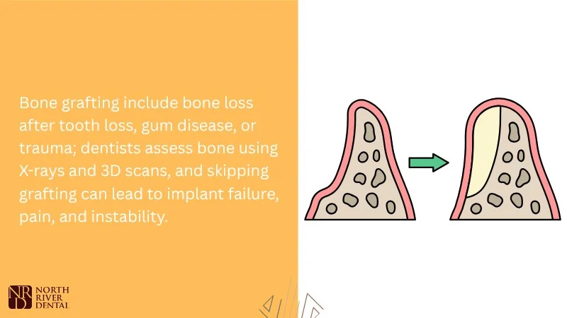 When Bone Grafting Is Needed for Dental Implants